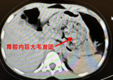 浙江一5歲女孩確診長發(fā)公主綜合征